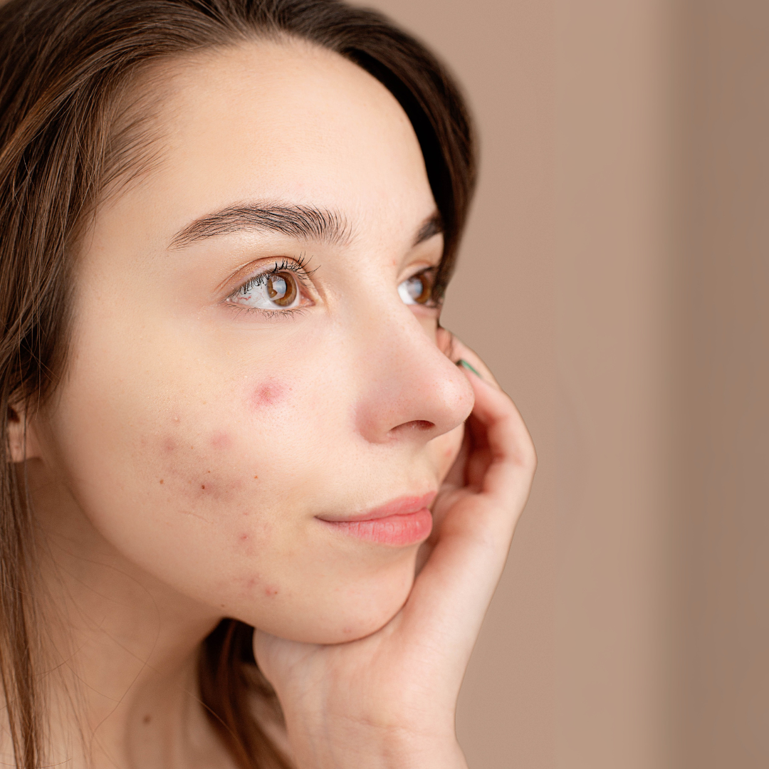 How to Treat (and Prevent) Summer Breakouts Naturally