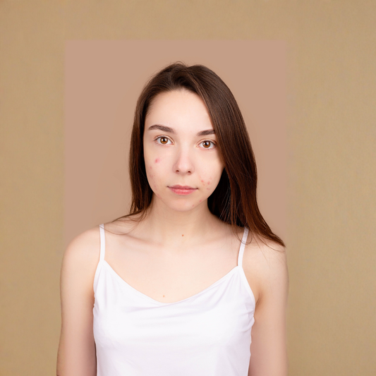 Beauty From Bees Spot Acne Treatment